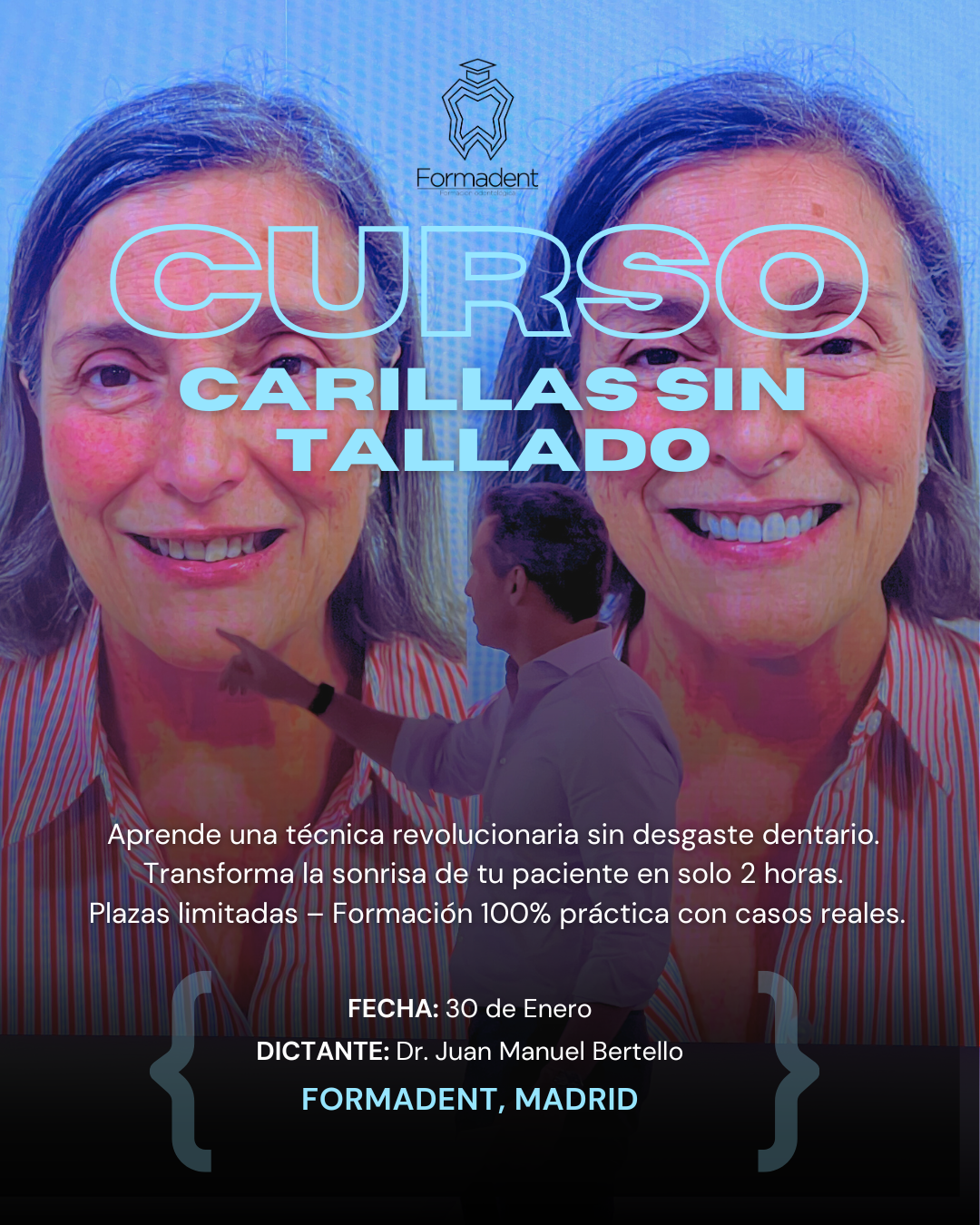 Carillas sin tallado