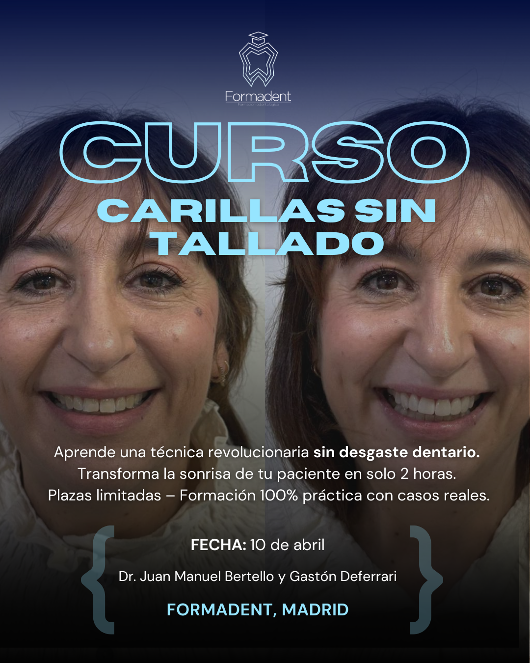 curso carillas sin tallado madrid